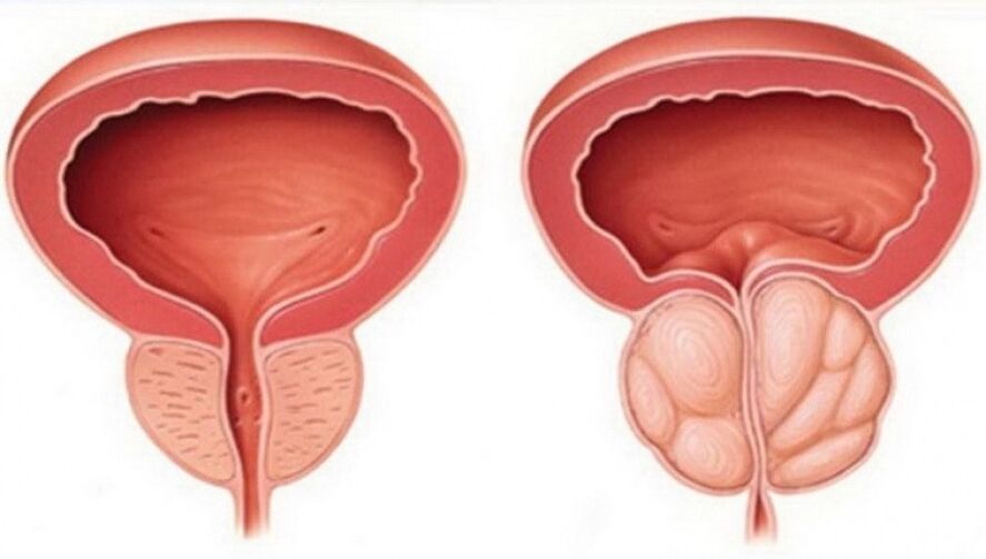 healthy prostate and inflamed prostate