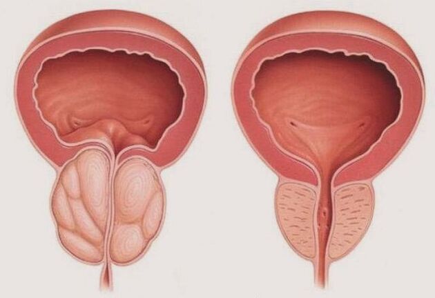 healthy prostate and inflamed prostate