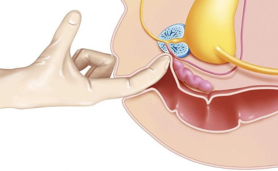 Prostate massage for the treatment of prostatitis