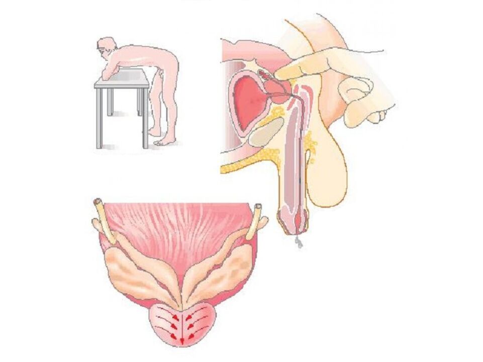 Prostate massage technique by a doctor to do a secretion analysis